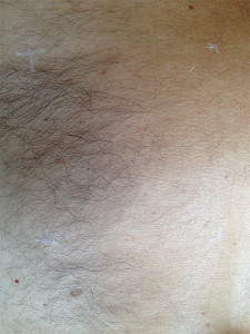 initia-laser-hair-removal-before