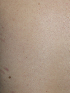 initia-laser-hair-removal-results