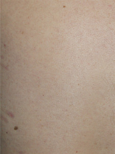 initia-laser-hair-removal-results